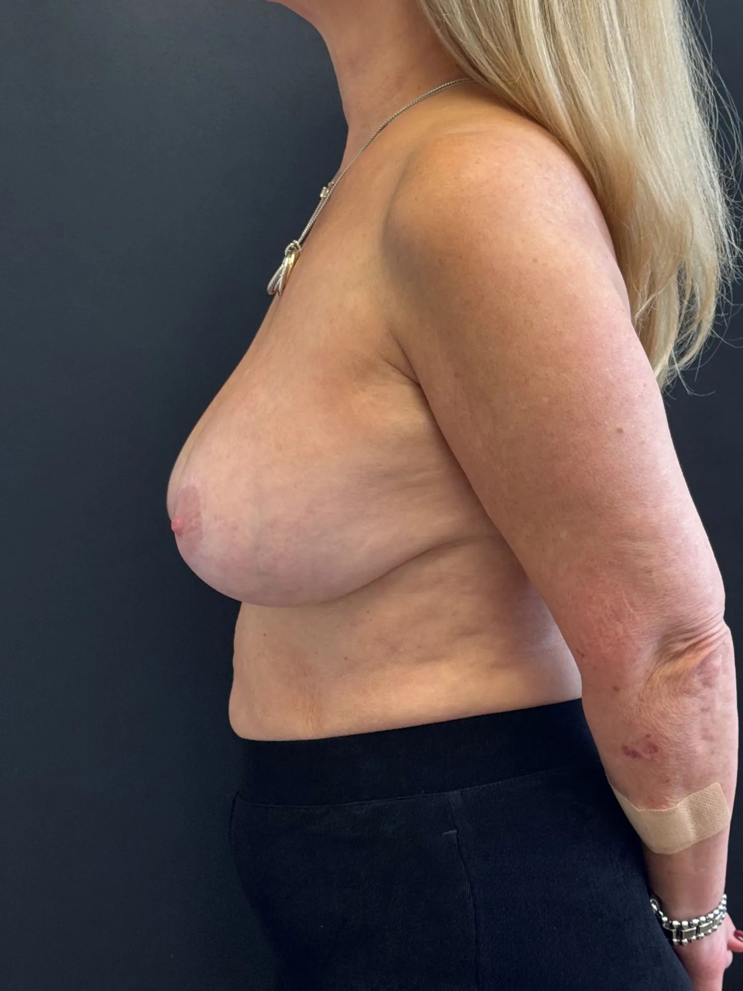 Breast Implant Exchange after — Breast Implant Removal and Replacement with Total Capsulectomy (for Grade 4 Capsular Contracture), view 3
