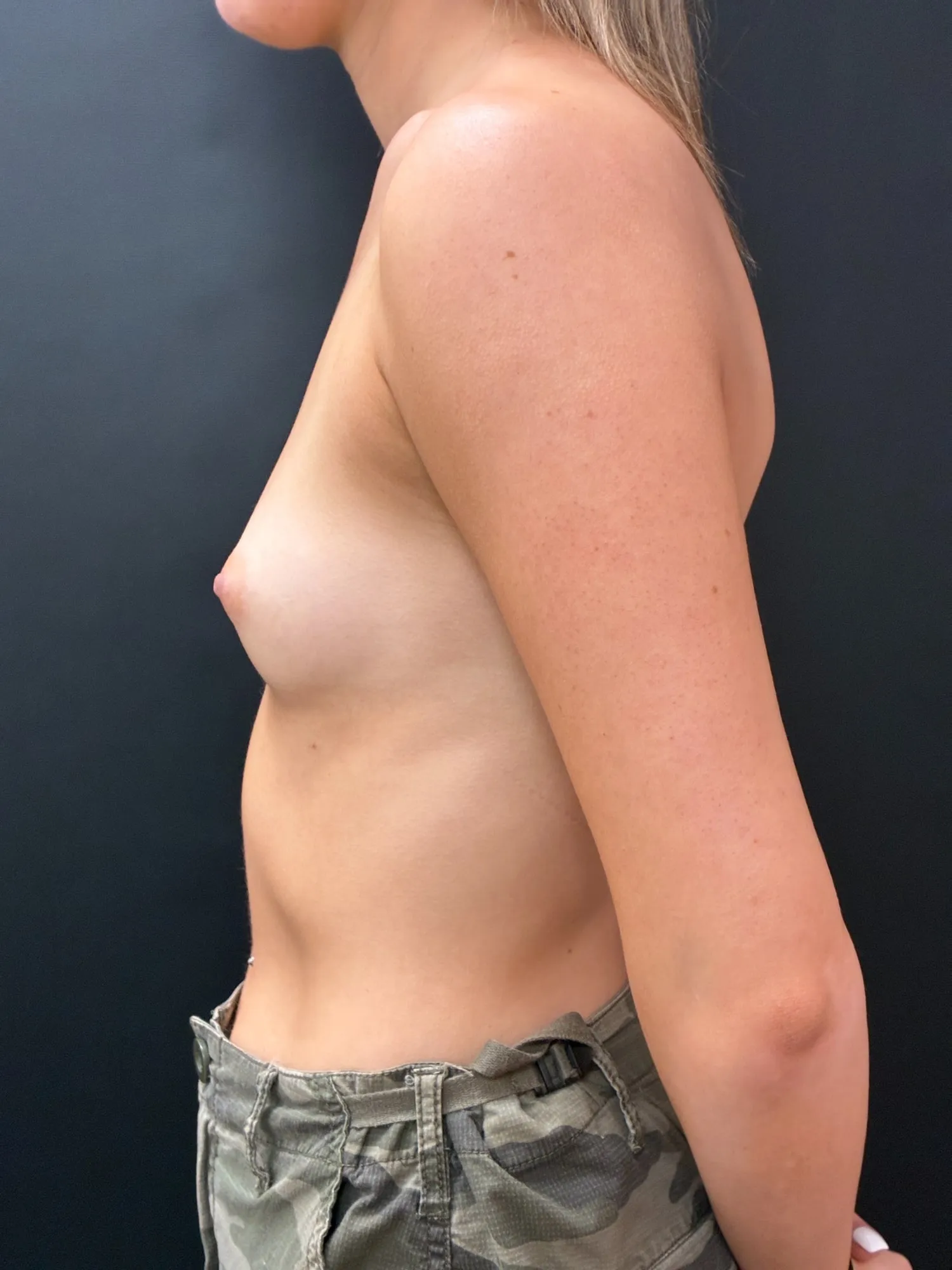 Breast Augmentation before — Breast Augmentation 300cc Motiva Ergonomix Demi, view 3
