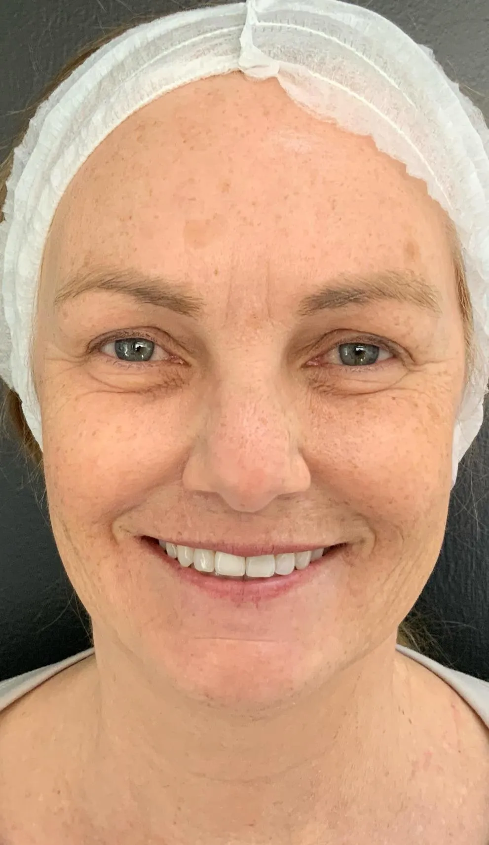 BBL Photorejuvenation before — BBL + HALO™ (1 treatment)