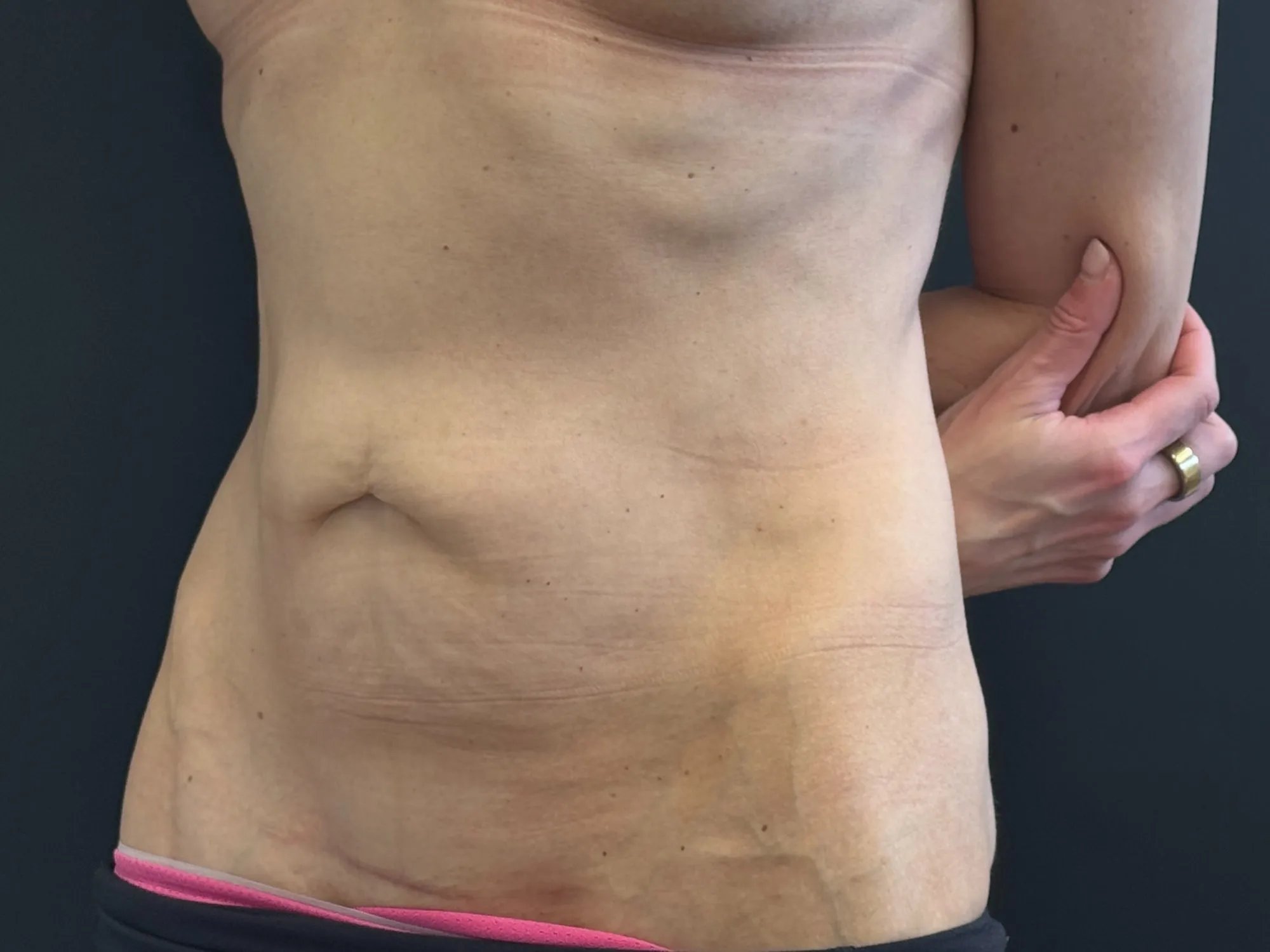Tummy Tuck and Liposuction before — Tummy Tuck, view 2