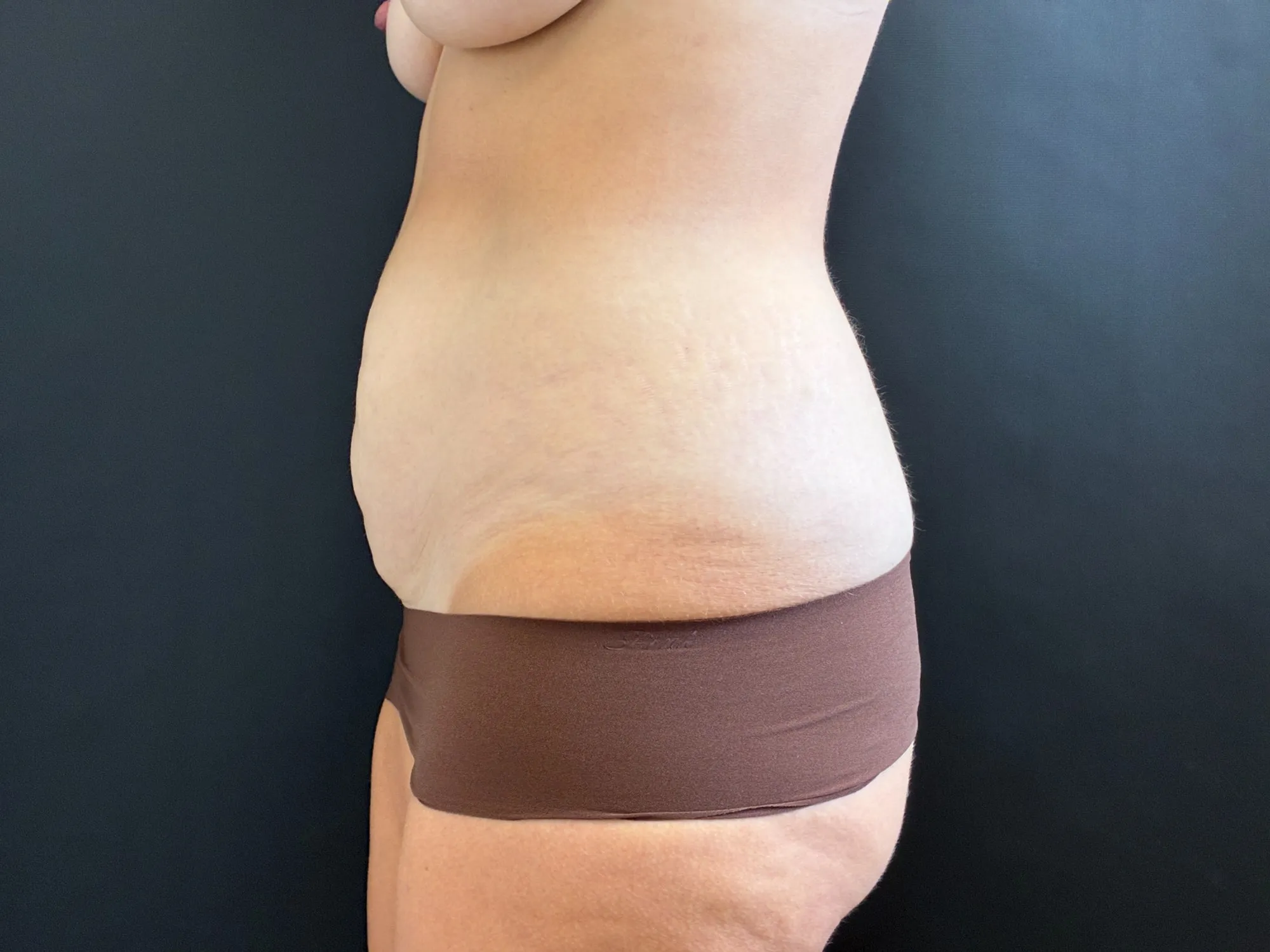 Tummy Tuck and Liposuction before — Tummy Tuck, view 3