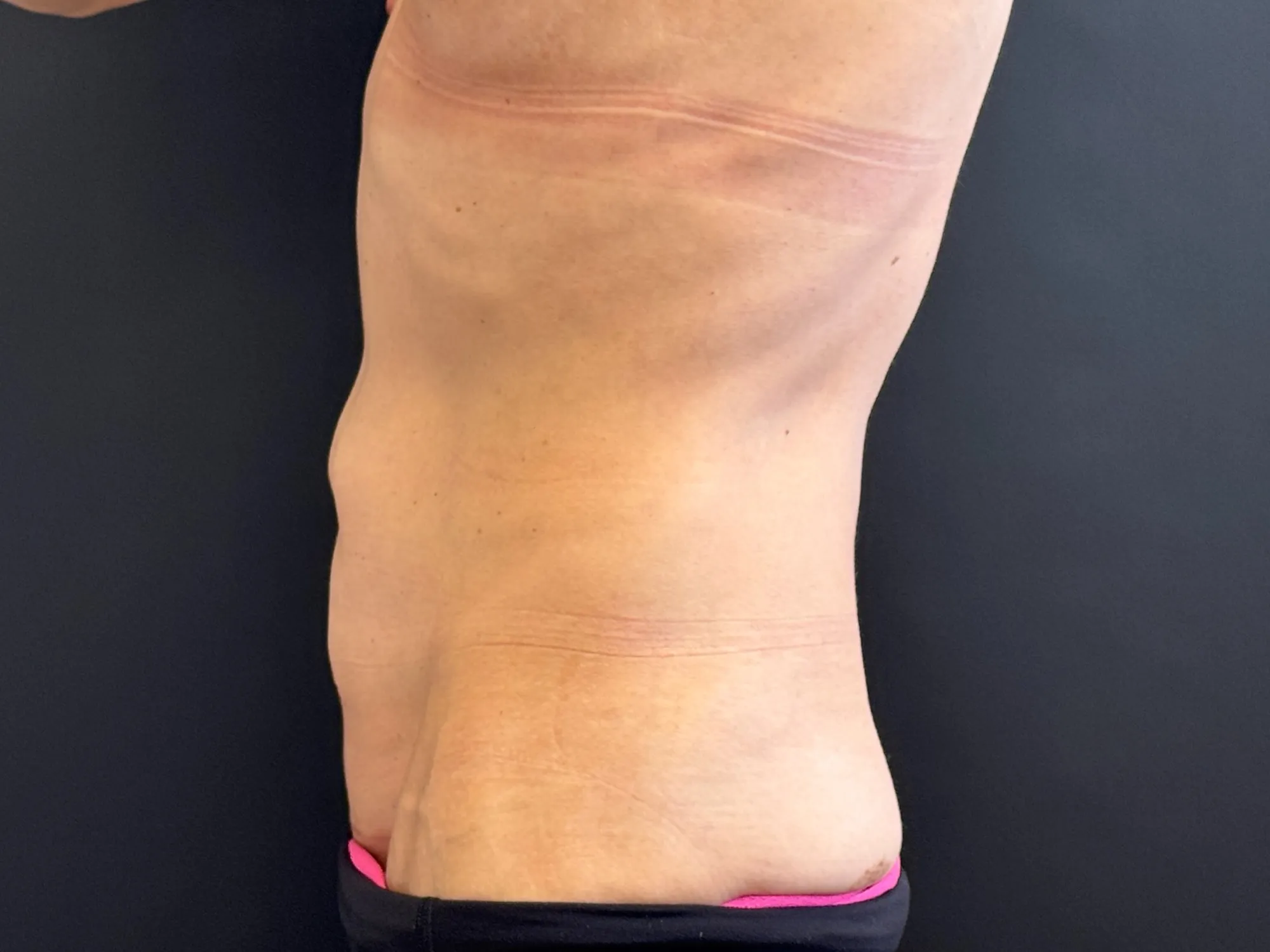 Tummy Tuck and Liposuction before — Tummy Tuck, view 3