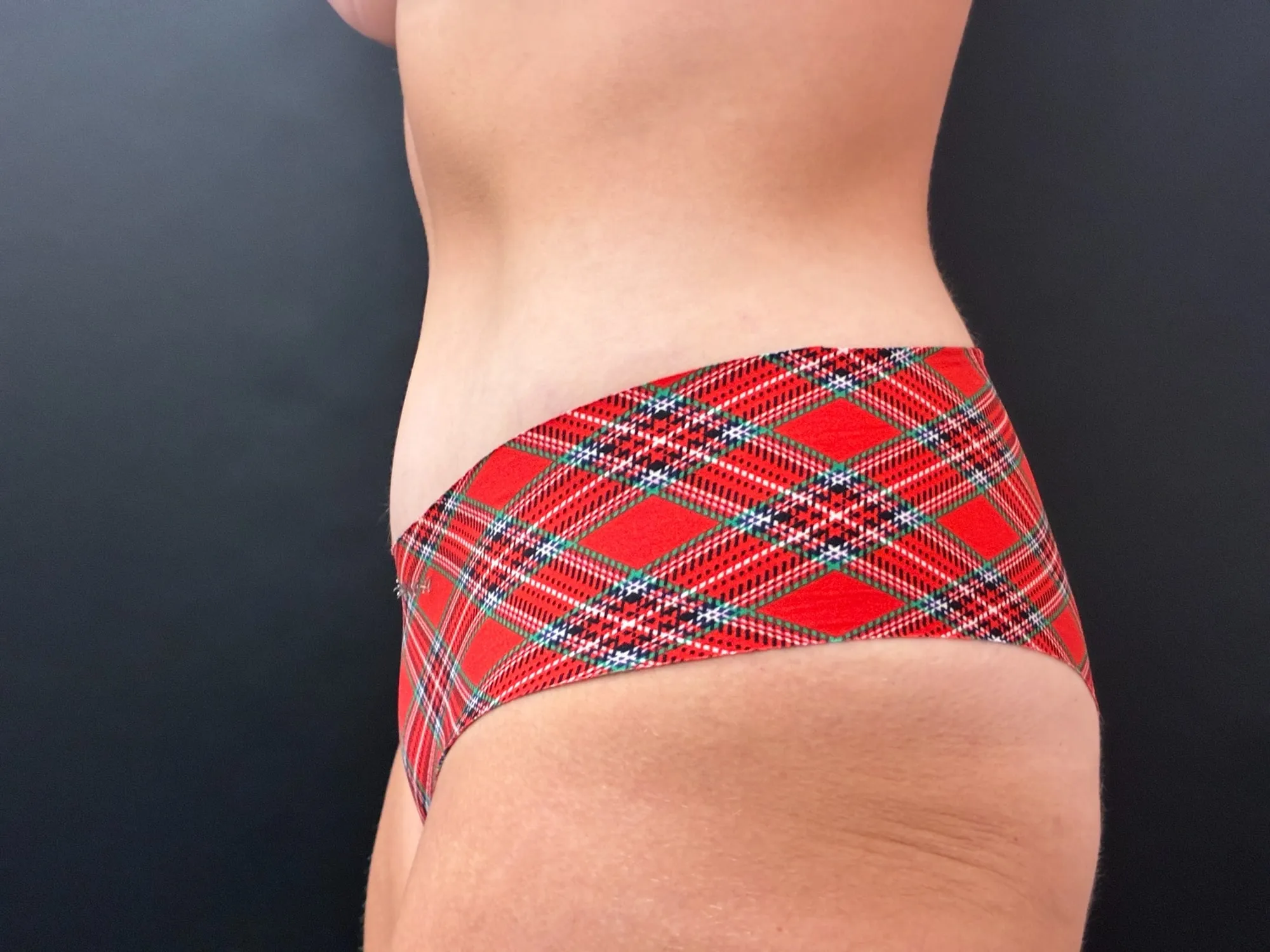 Tummy Tuck and Liposuction after — Tummy Tuck, view 3