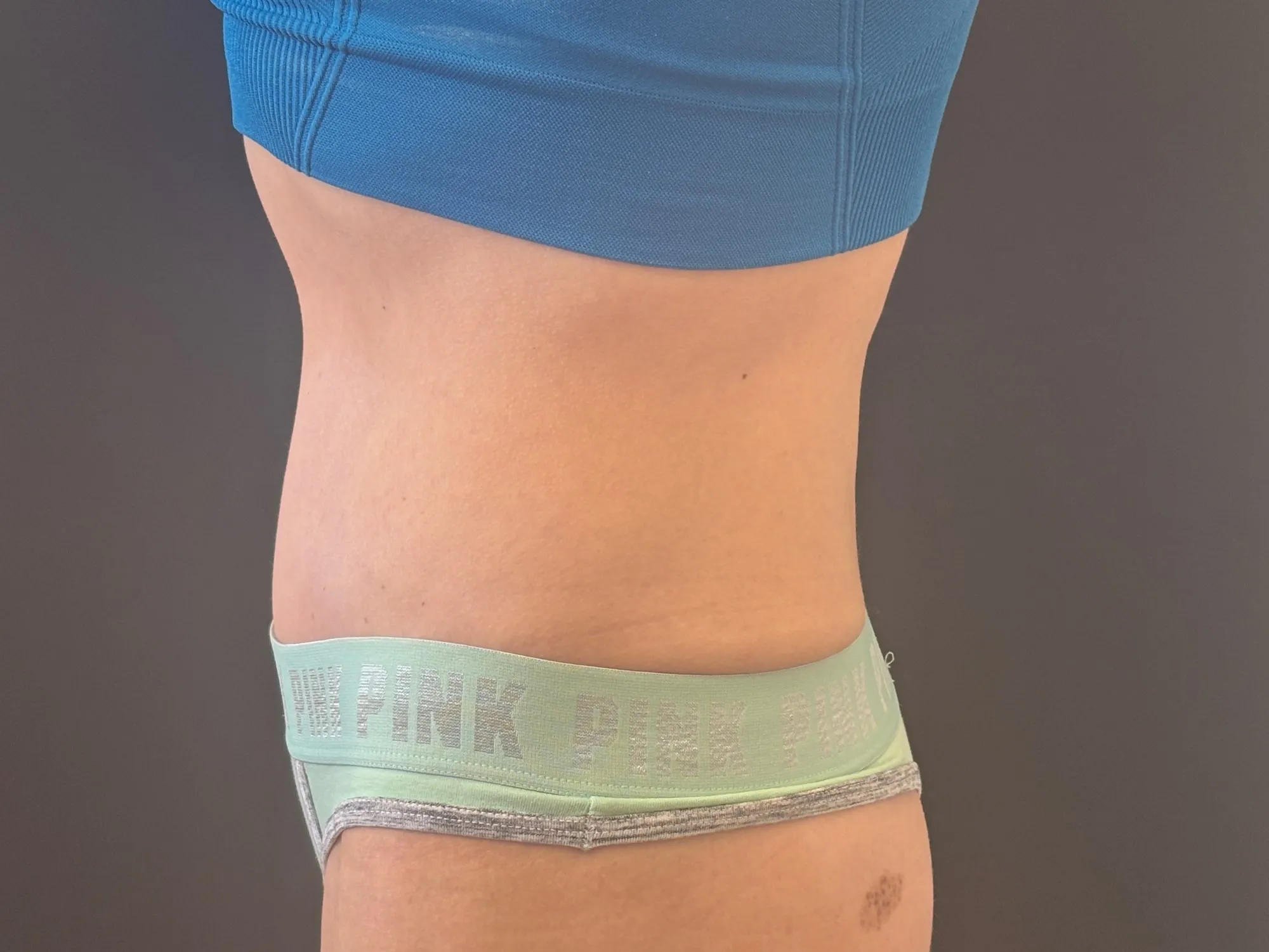 Tummy Tuck and Liposuction after — Tummy Tuck, view 3