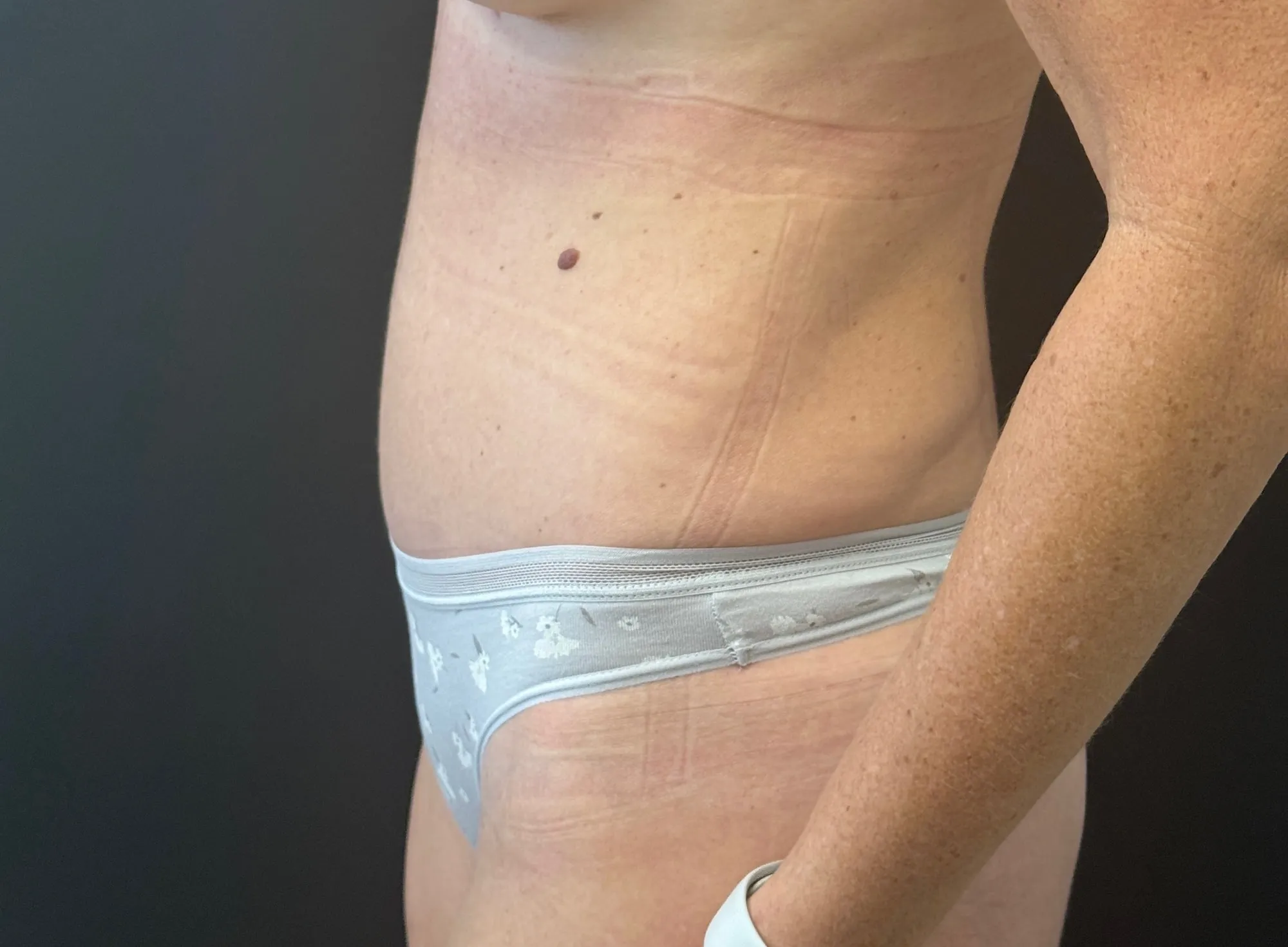 Tummy Tuck and Liposuction after — Tummy Tuck, view 3