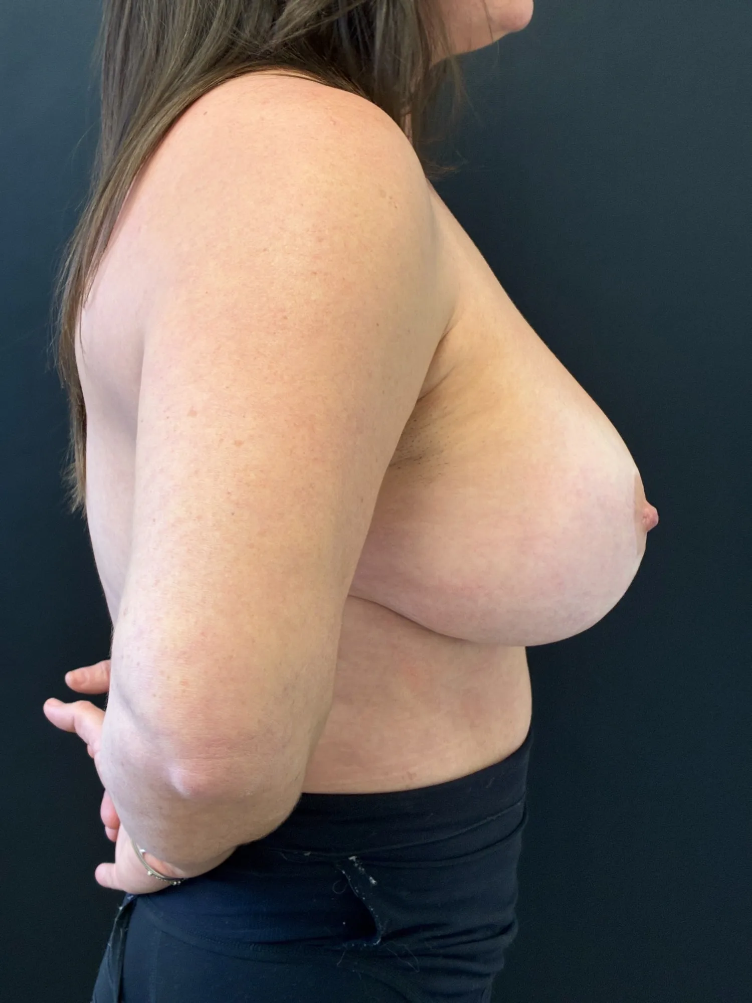 Breast Implant Revision before — Breast Implant Downsize with Revision Breast Lift, view 3