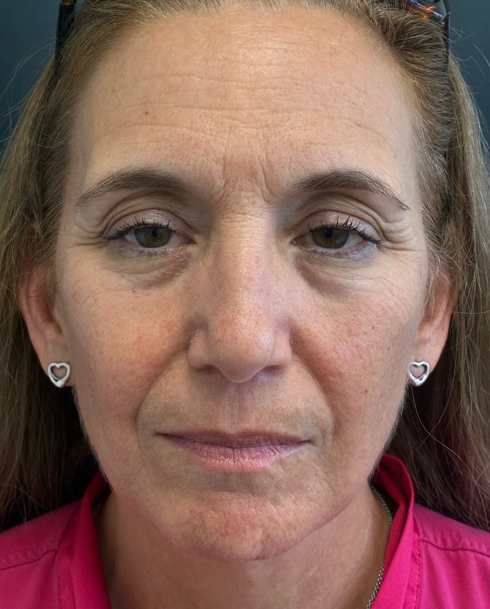 Brow Lift before — Brow Lift, view 1