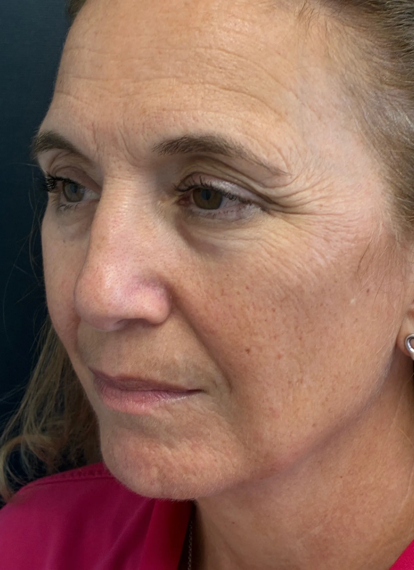 Brow Lift before — Brow Lift, view 2