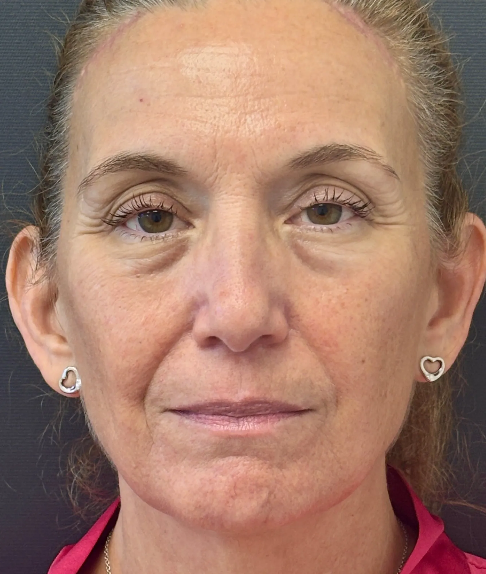 Brow Lift after — Brow Lift, view 1