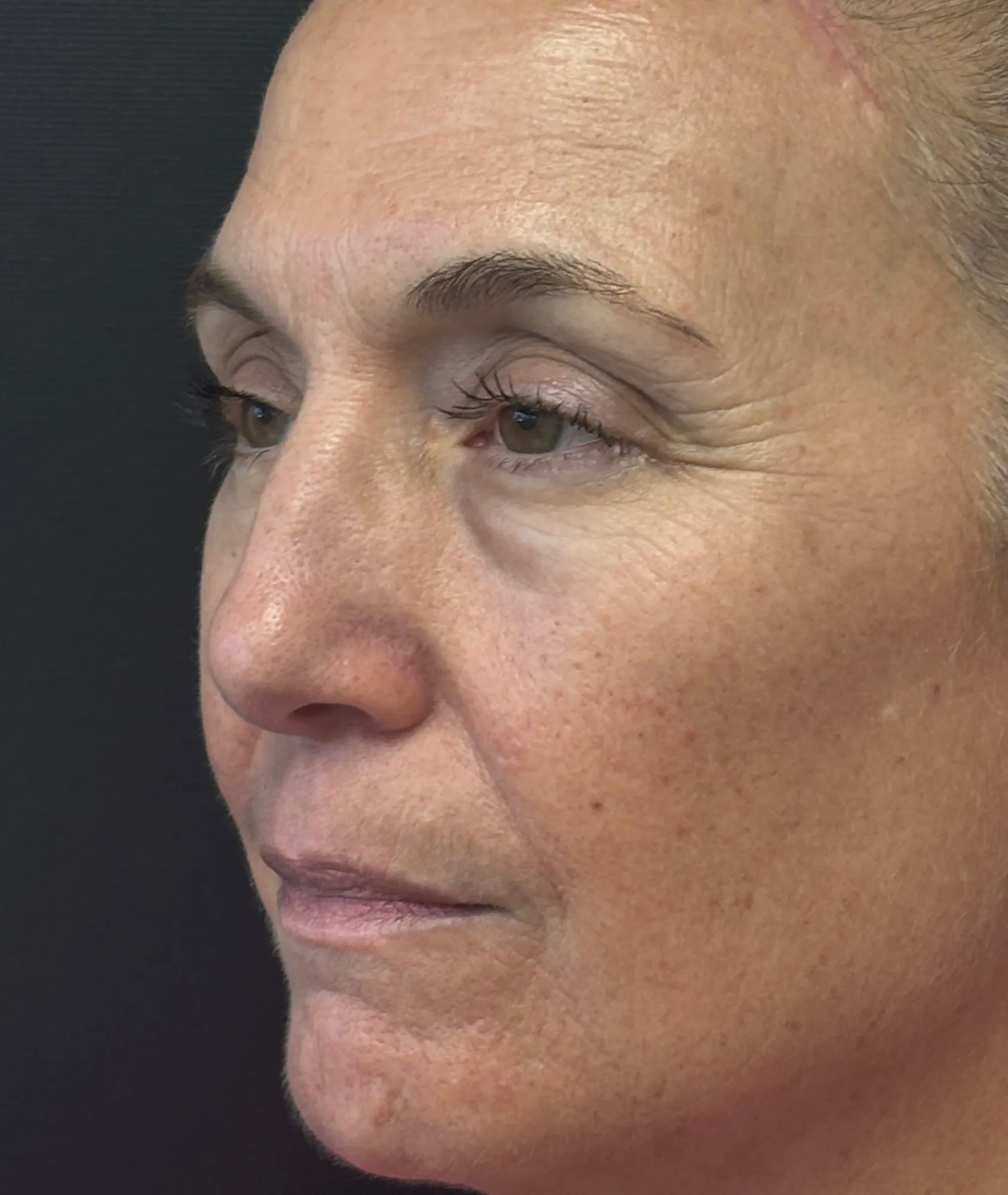 Brow Lift after — Brow Lift, view 2