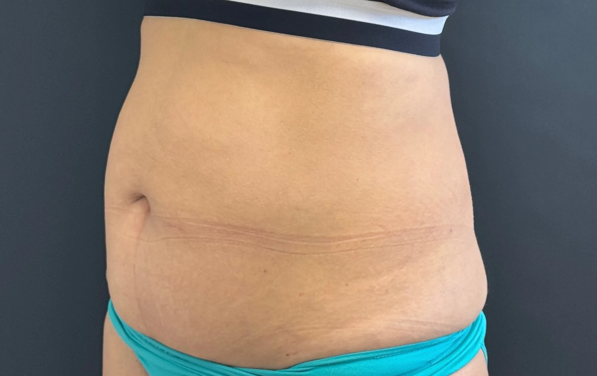 Tummy Tuck and Liposuction before — Tummy Tuck, view 2