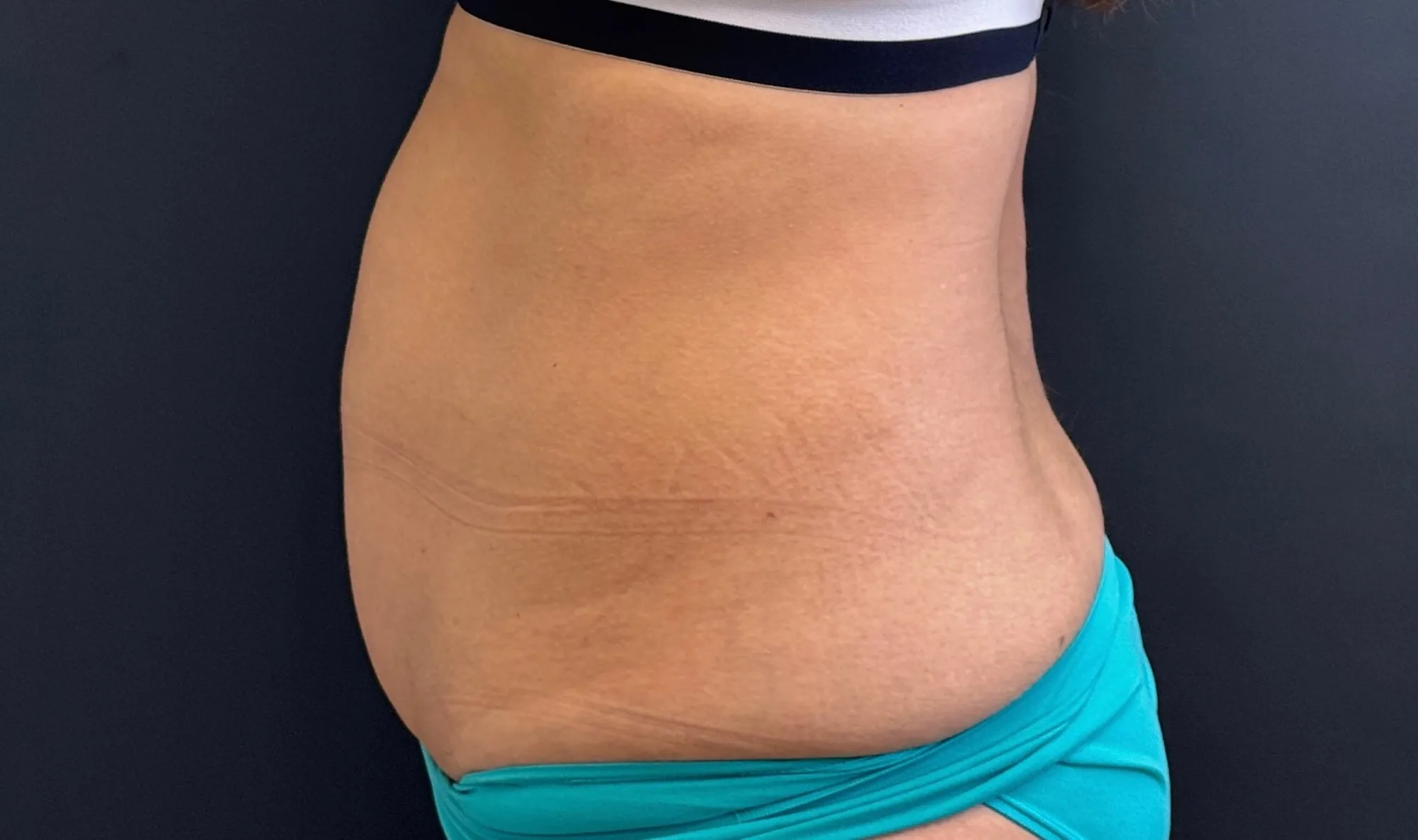 Tummy Tuck and Liposuction before — Tummy Tuck, view 3