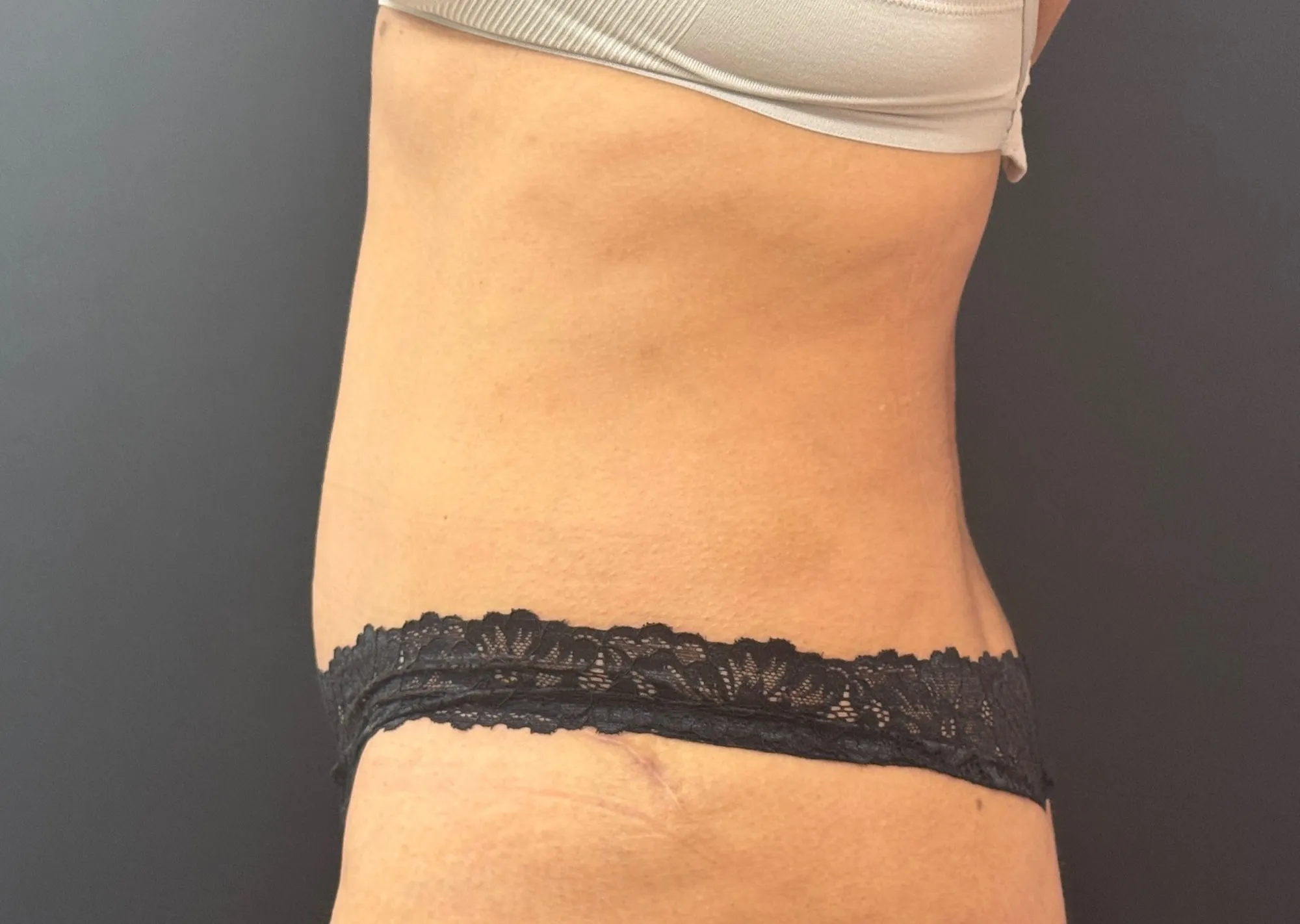 Tummy Tuck and Liposuction after — Tummy Tuck, view 3